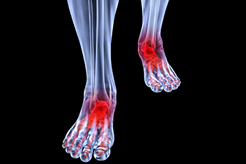 Arthritic foot and ankle care treatment in the Brooklyn, NY 11229 and Astoria, NY 11103 areas