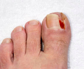 Ingrown toenails treatment in the Brooklyn, NY 11229 and Astoria, NY 11103 areas